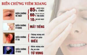 triệu chứng viêm xoang nặng